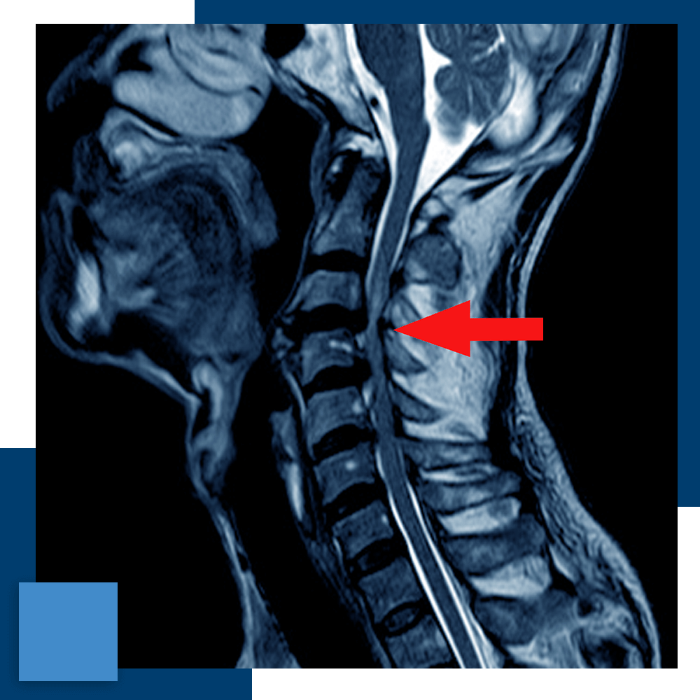 5050_1 an MRI scan of a cervical disc