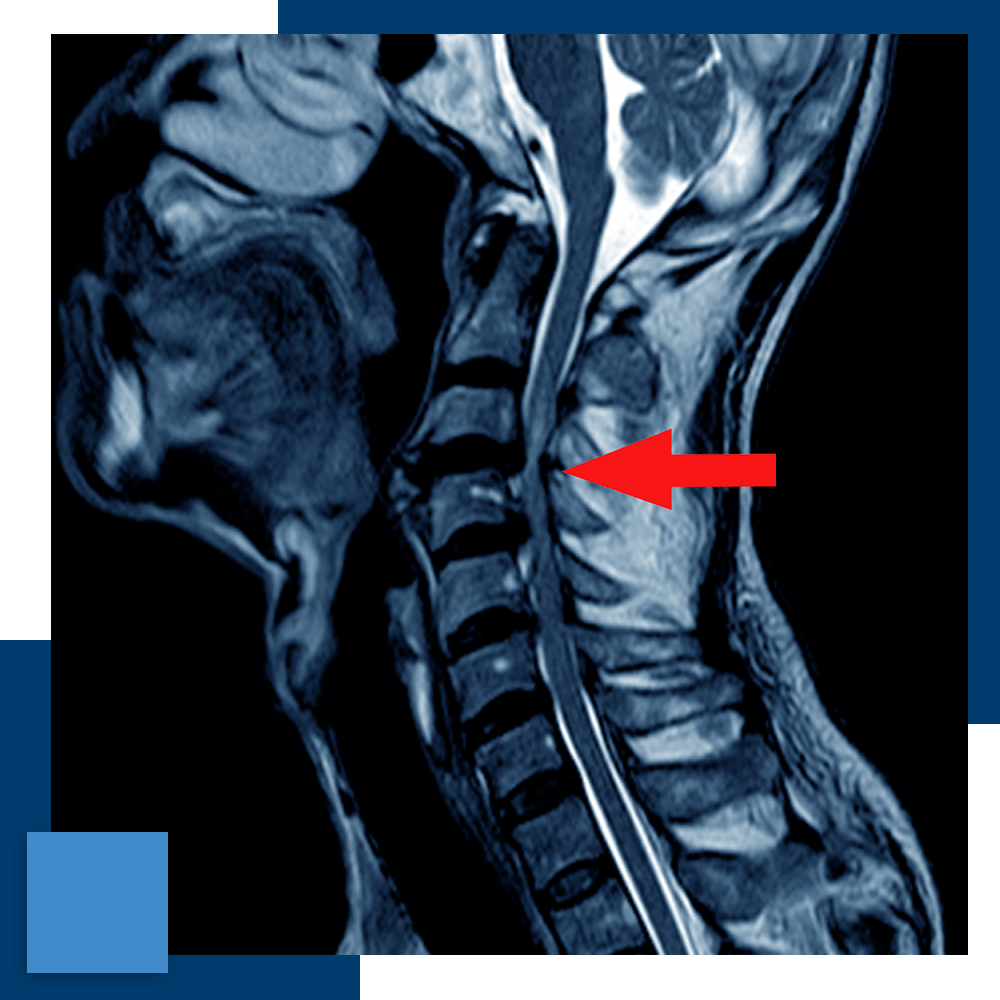 an MRI scan of a cervical disc