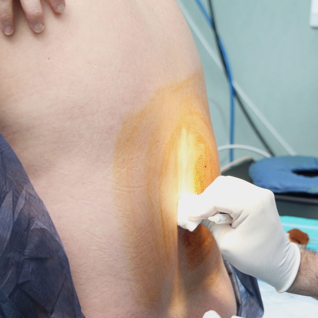 applying anesthetic to patient's back